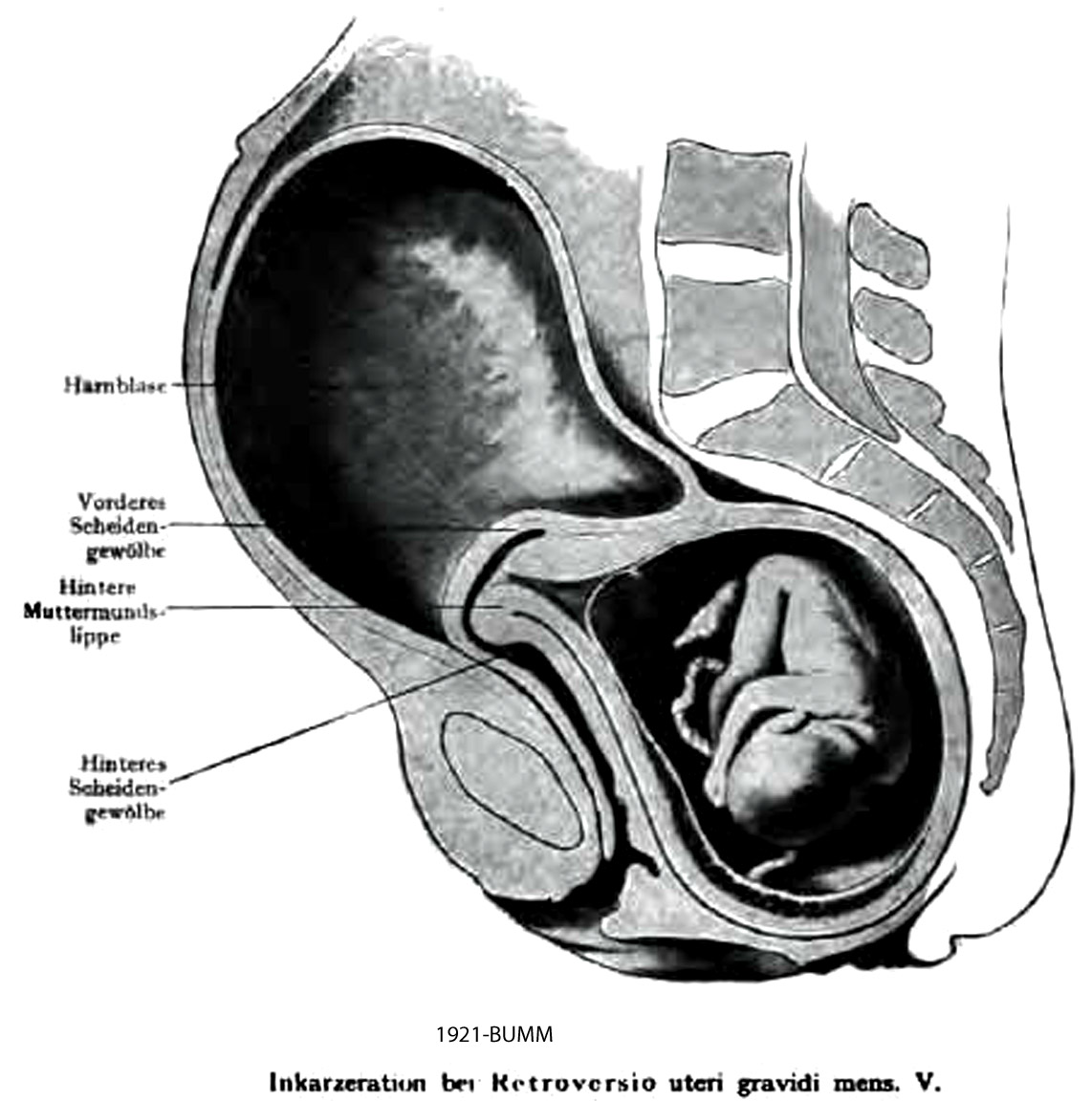 A Case Of Uterine Incarceration With Unrecognized Uterine 60 OFF a-case-of-uterine-incarceration-with-unrecognized-uterine-60-off