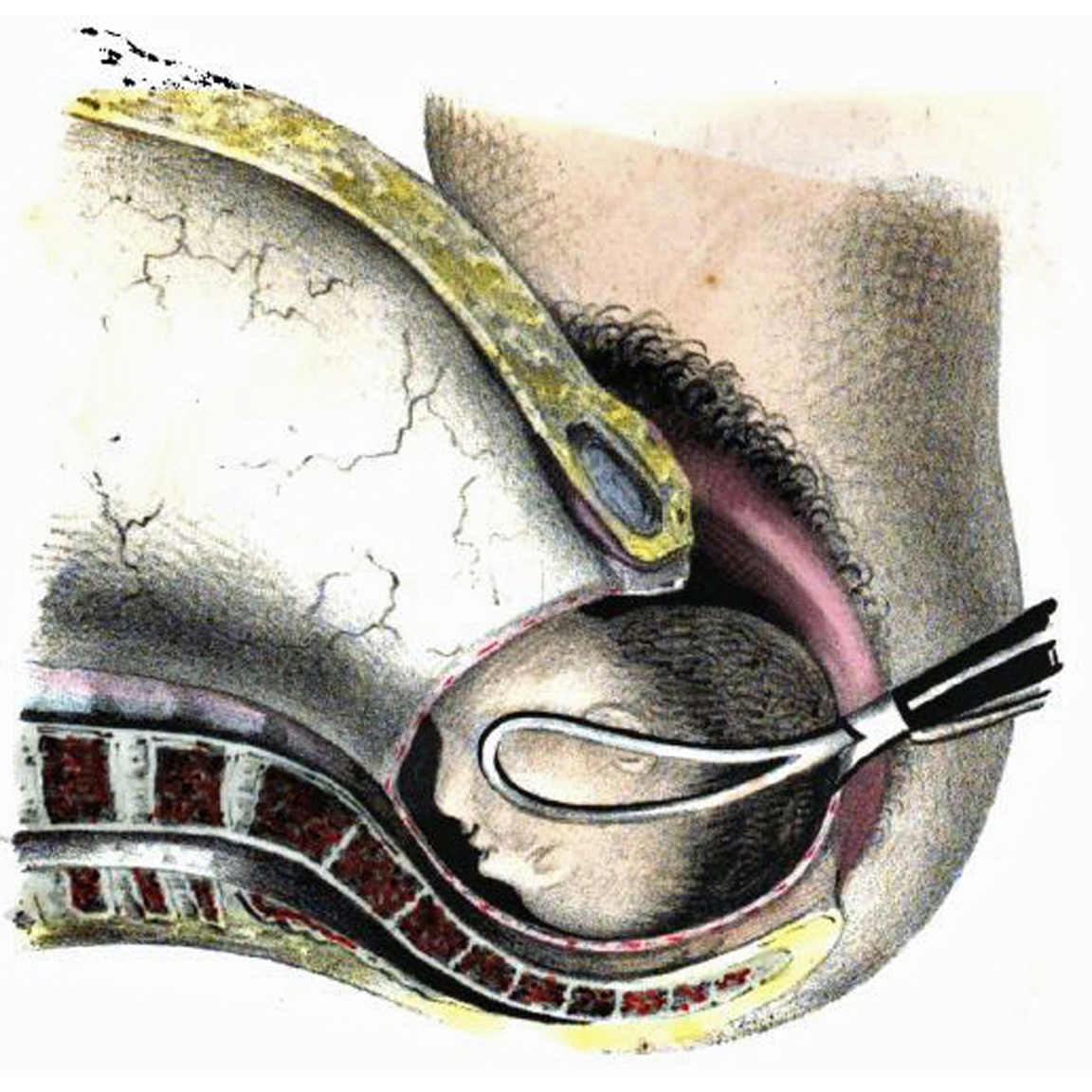 1850 BEACH: forceps delivery