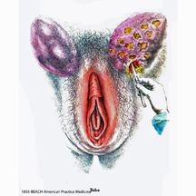 1855-BEACH-Drainage of L groin abscess