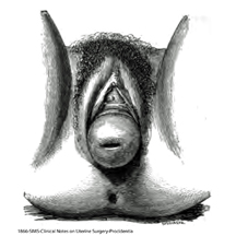 1866-SIMS-procidentia