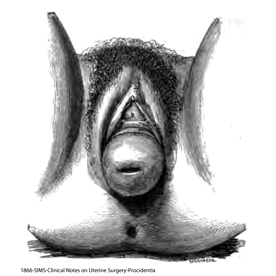1866-SIMS-procidentia