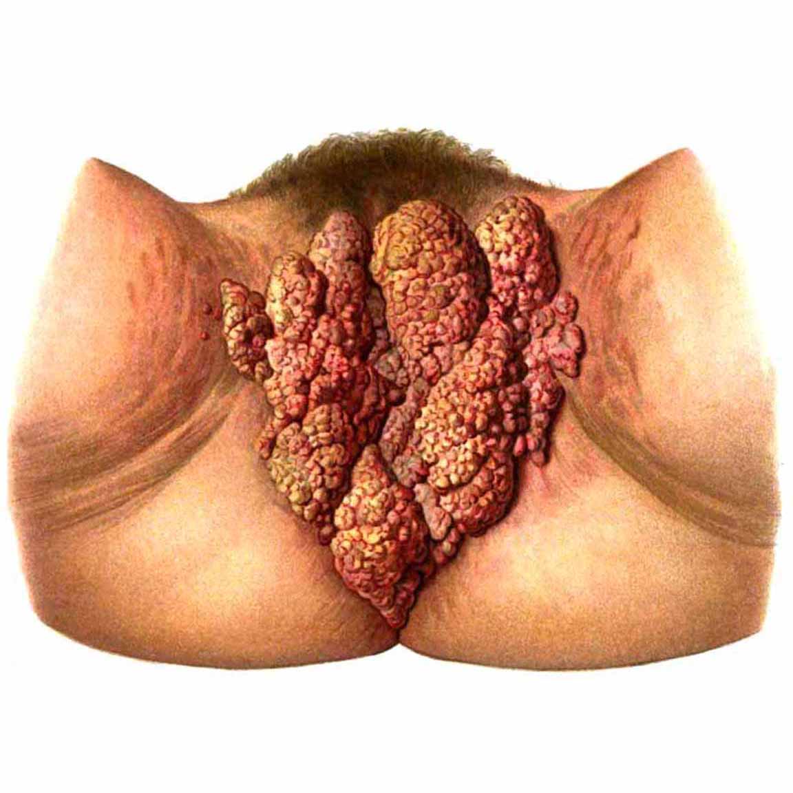 1898 vulvar condylomata