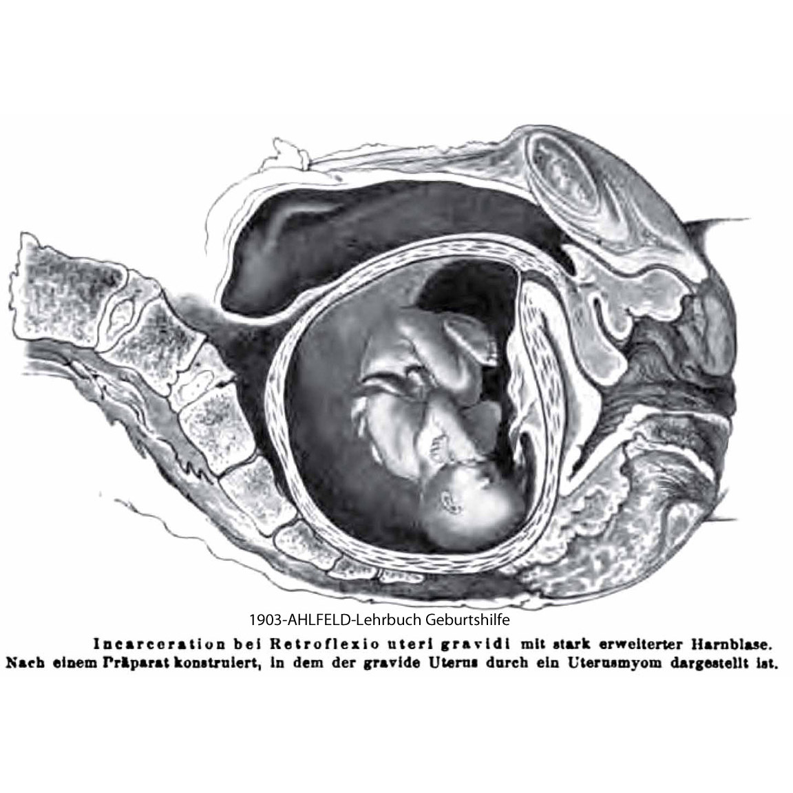 1903-AHLFELD-incarceration 
                of the RV uterus in early pregnancy
