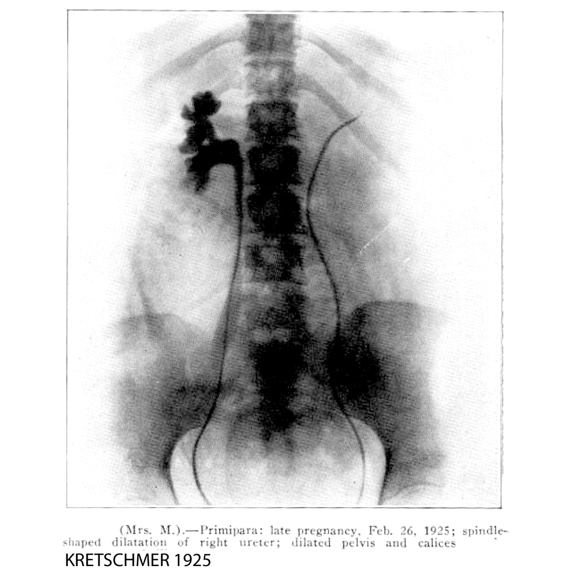 1925-KRETSCHMER-DilationUreter-OBS