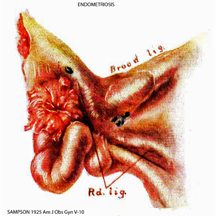 1925-SAMPSON-Endometriosis