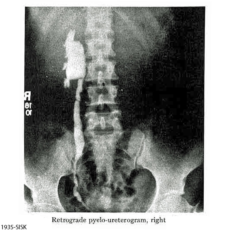 Retrograde pyelogram