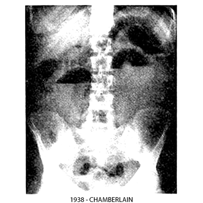 X-Ray showing air-fluid levels.