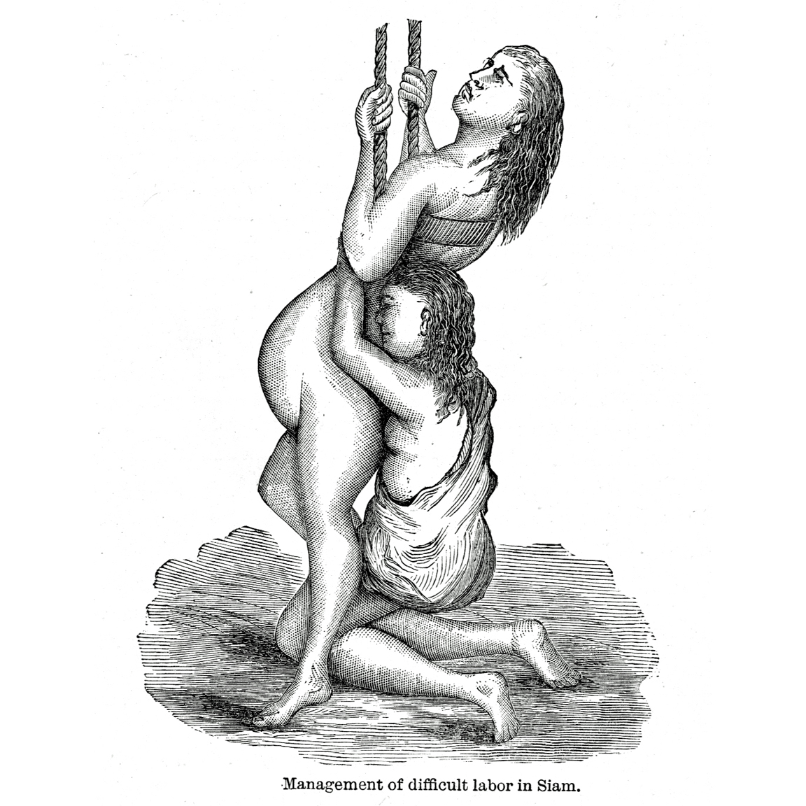 Difficult Birth in Siam