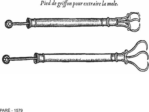 Hydatidiform Mole Extractor 1579