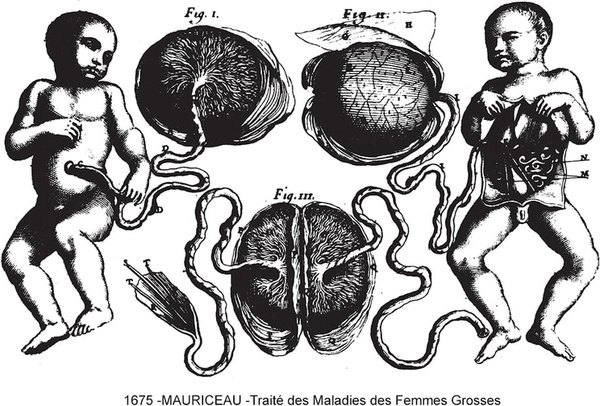 Sketch showing Di-Di twins after birth, with separate placentas; from 1675 Mauriceau book.