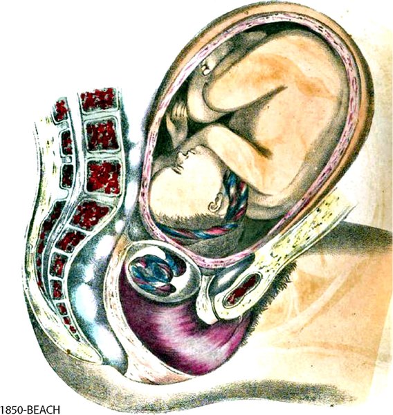 Cord Prolapse