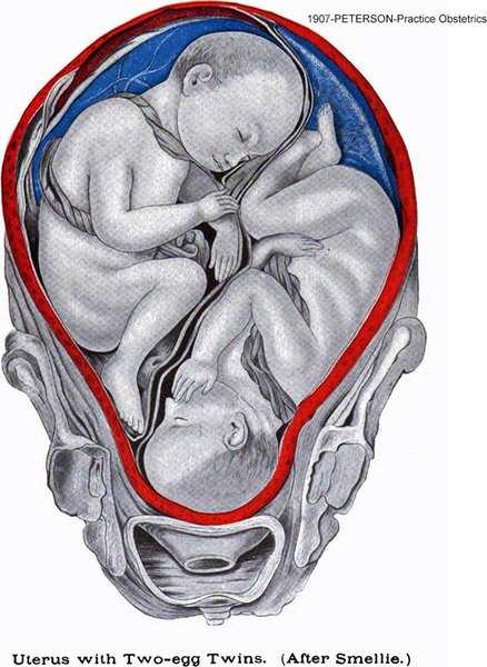 1907 colored sketch of Di-Di twins in-utero, based on classic Smellie Atlas
