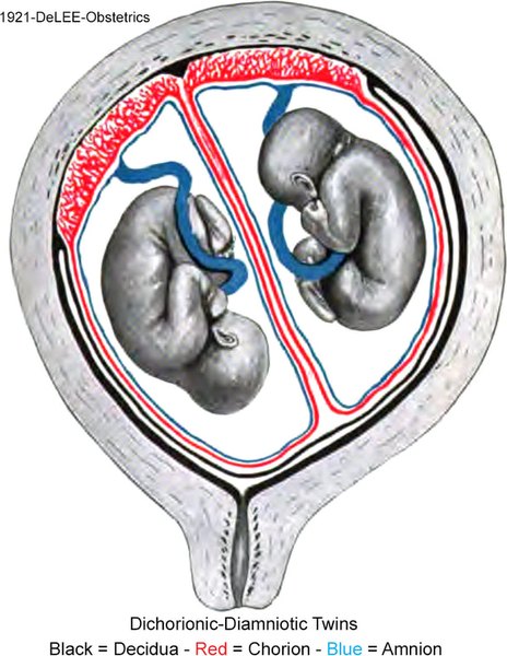 Diagram of Di-Di Twins in-utero. DeLEE 1921