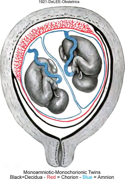 Diagram of Mo-Mo Twins in-utero. DeLEE 1921
