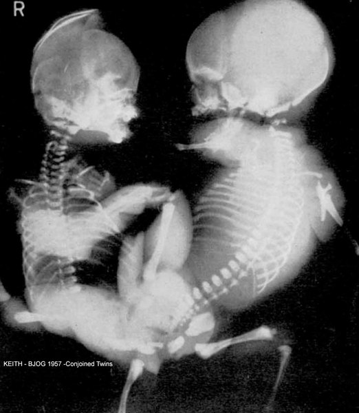 X-Ray Conjoined Twins