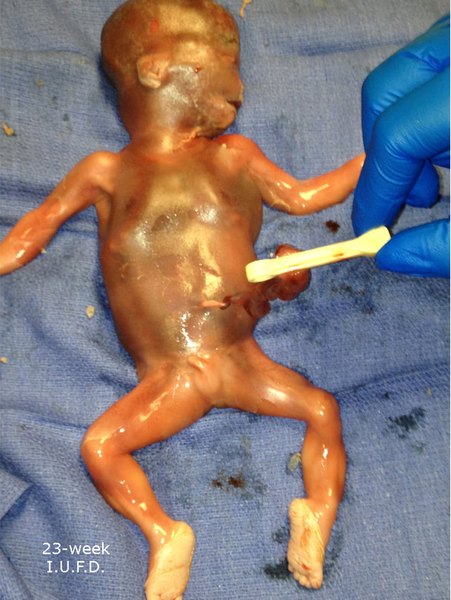 23w Stillborn