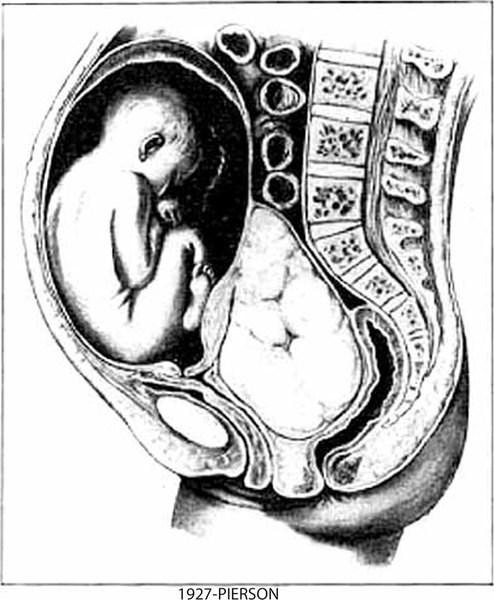 Fibroids & Pregnancy