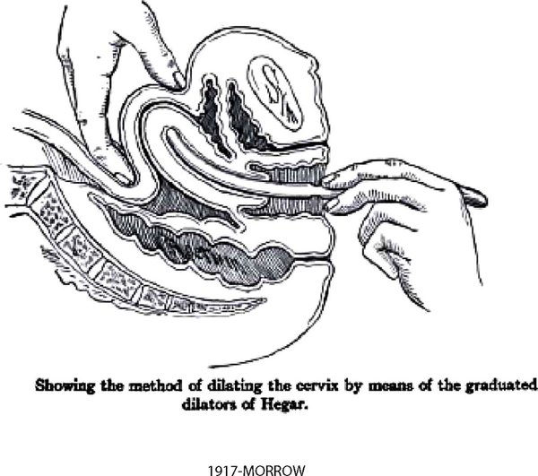 Minor GYN Surgery