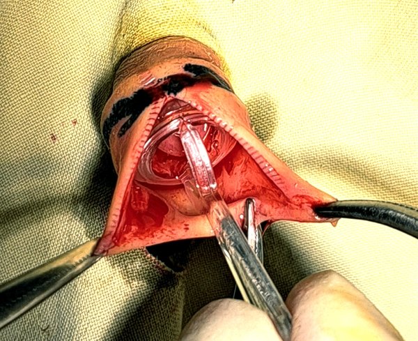 Clamp procedure