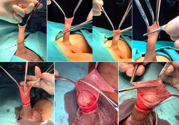Circumcision