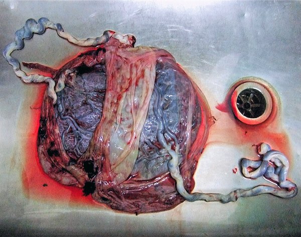Modern photo of twin placenta in a stainless steel sink, right after delivery.